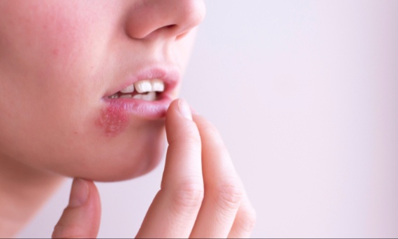 Czym smarować liszaj na twarzy?