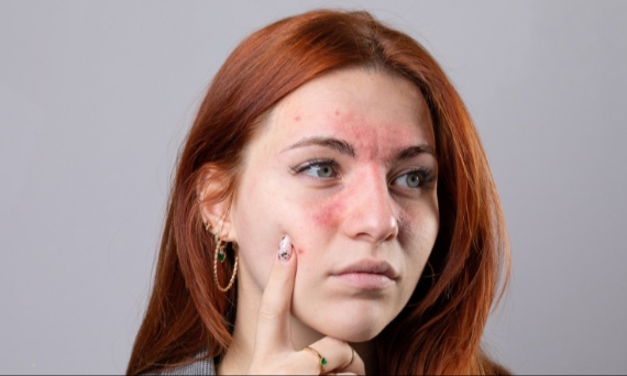 Dlaczego trądzik różowaty powraca?