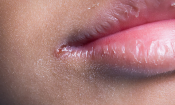 Dlaczego zajady się nie goją?